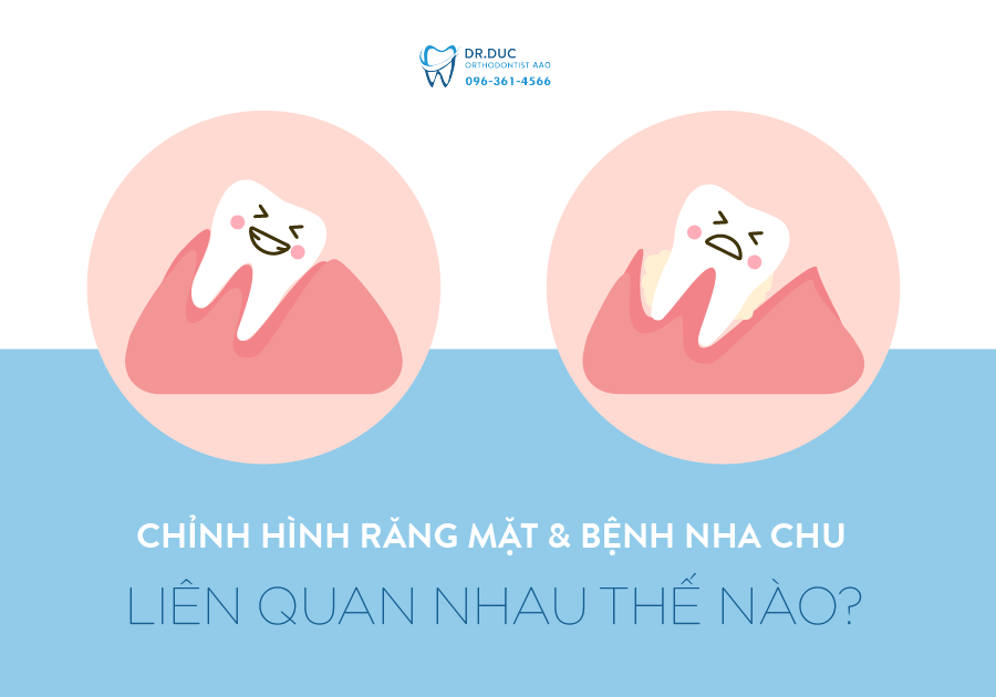 Chỉnh hình răng mặt và bệnh nha chu liên quan nhau thế nào? 1 Chỉnh hình răng mặt và bệnh nha chu liên quan nhau thế nào? 1