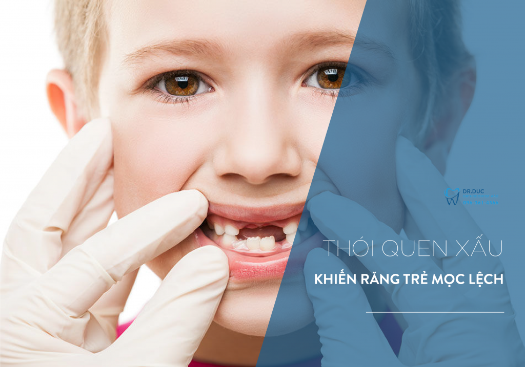 Thói quen xấu khiến răng trẻ mọc lệch lạc 1 Thói quen xấu khiến răng trẻ mọc lệch lạc 1