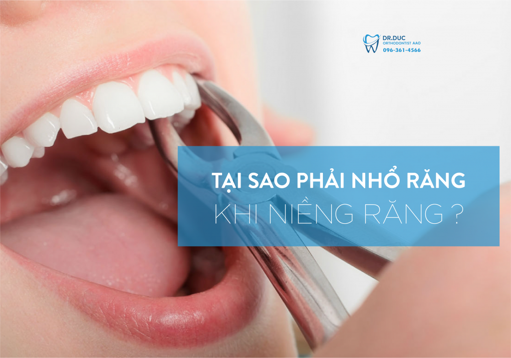Niềng răng có cần nhổ răng không ? 1 Niềng răng có cần nhổ răng không ? 1