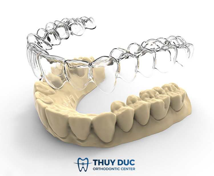Quy trình chế tác khay niềng Invisalign chuẩn quốc tế 1 Quy trình chế tác khay niềng Invisalign chuẩn quốc tế 1