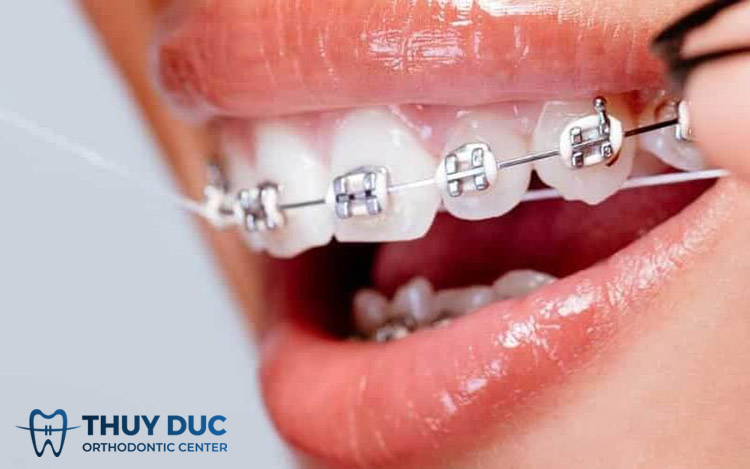 Chỉ nha khoa – ưu và nhược điểm 1