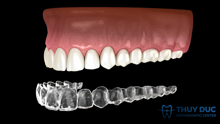 Chi phí niềng răng trong suốt Invisalign dựa vào yếu tố nào? 1 Chi phí niềng răng trong suốt Invisalign dựa vào yếu tố nào? 1