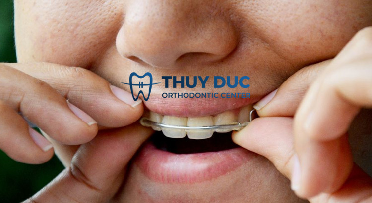 Bạn cần đeo hàm duy trì trong thời gian bao lâu? 1