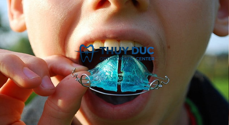 Điều gì sẽ xảy ra nếu như bạn không đeo hàm duy trì hoặc đeo không đúng cách? 1