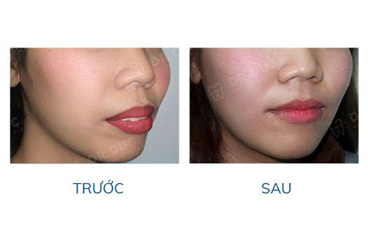 Niềng răng có hết lẹm cằm không? 1 Niềng răng có hết lẹm cằm không? 1