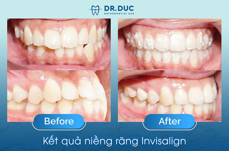 Đánh giá của khách hàng về niềng răng Invisalign nha khoa Thuý Đức 2 Đánh giá của khách hàng về niềng răng Invisalign nha khoa Thuý Đức 2