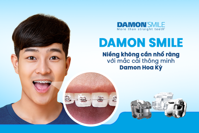 Niềng răng mắc cài Damon có hiệu quả không? 1 Niềng răng mắc cài Damon có hiệu quả không? 1