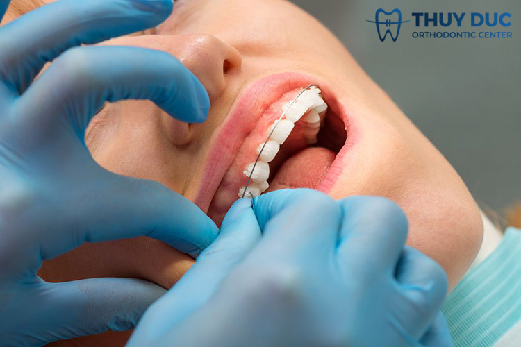 Nếu không có sáp nha khoa thì giải pháp thay thế là gì? 1 Nếu không có sáp nha khoa thì giải pháp thay thế là gì? 1