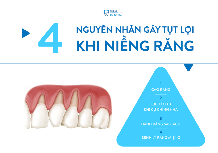Nguyên nhân khiến niềng răng bị tụt lợi 1 Nguyên nhân khiến niềng răng bị tụt lợi 1