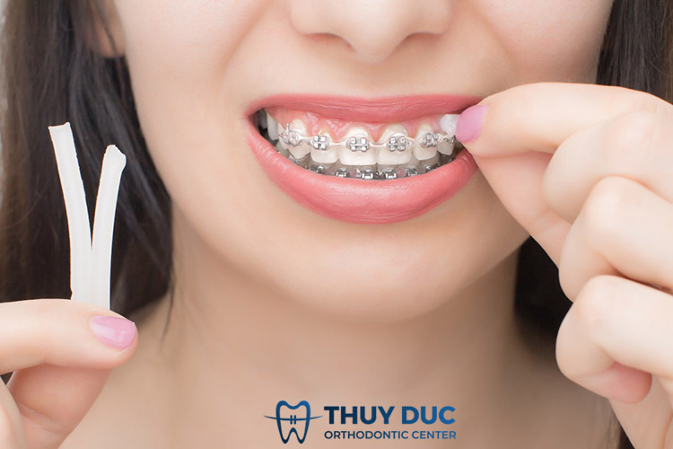 Những lưu ý quan trọng khi dùng sáp nha khoa 1 Những lưu ý quan trọng khi dùng sáp nha khoa 1