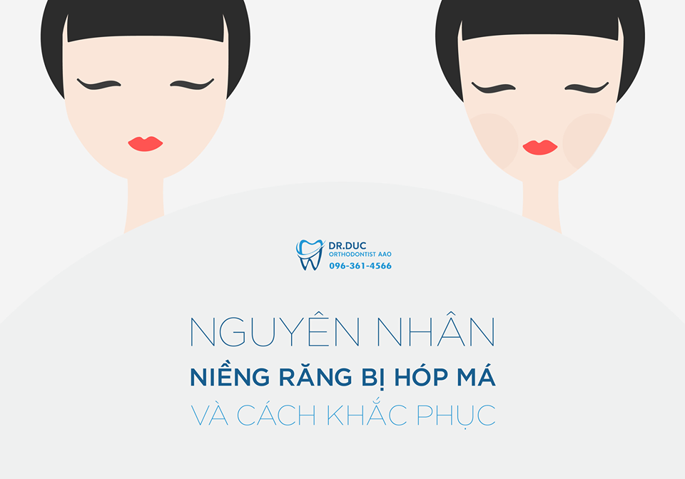 Niềng răng bị hóp má – Nguyên nhân và cách khắc phục 1 Niềng răng bị hóp má – Nguyên nhân và cách khắc phục 1