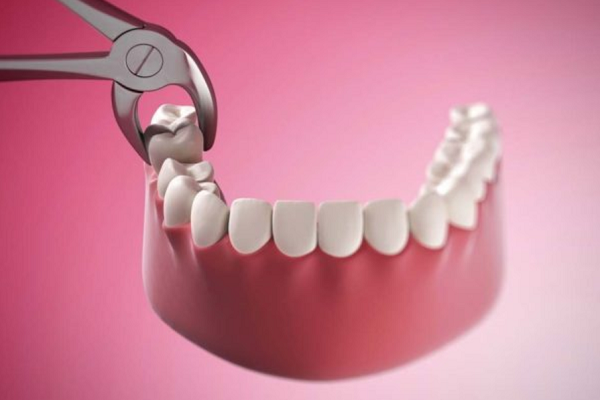 Niềng răng có cần nhổ không và những lưu ý 1 Niềng răng có cần nhổ không và những lưu ý 1