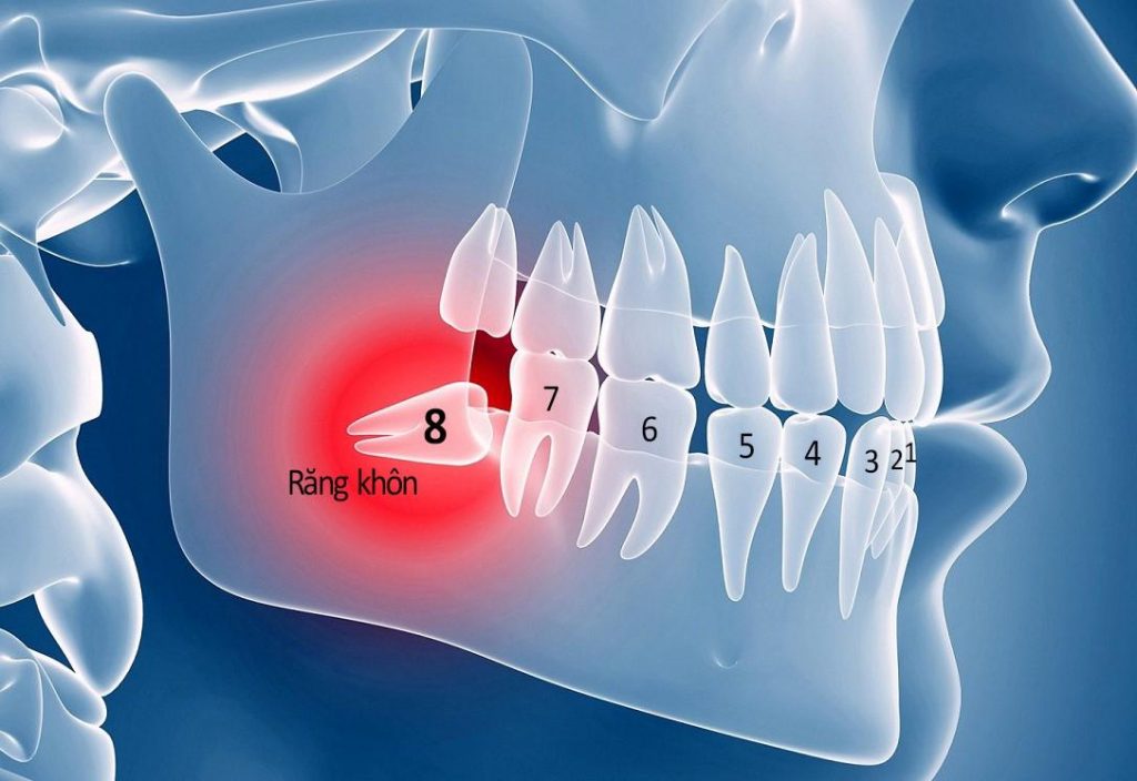 Niềng răng có cần nhổ răng khôn không? - Bác sĩ Đức AAO