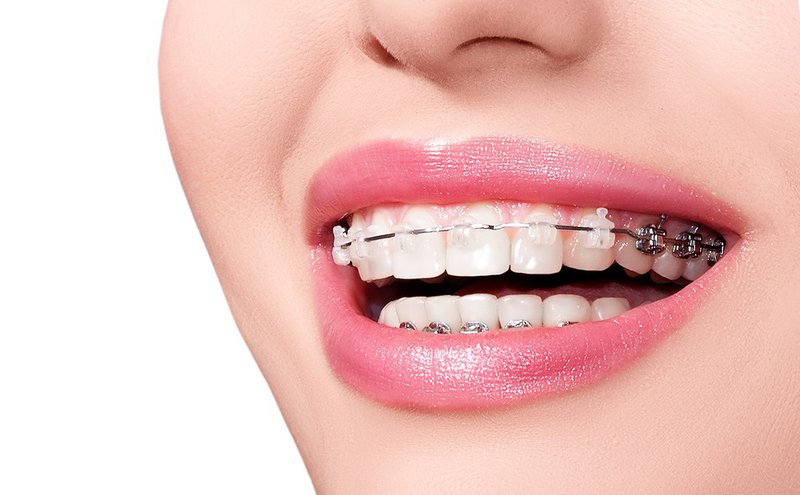 Niềng răng (chỉnh nha) là gì? 1 Niềng răng (chỉnh nha) là gì? 1