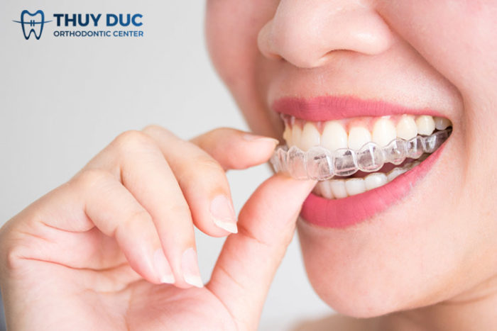 Hiểu lầm về niềng răng vô hình Invisalign mà bạn chưa biết 1