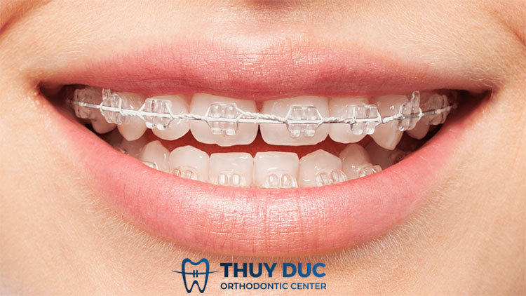 Các phương pháp niềng răng 2