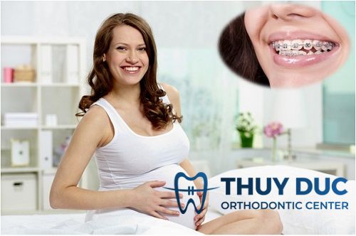 Niềng răng khi mang thai - Lợi ích và mặt trái 1 Niềng răng khi mang thai - Lợi ích và mặt trái 1
