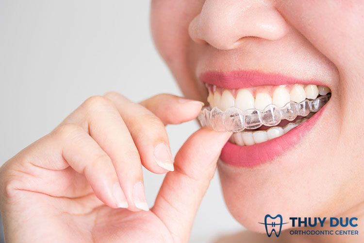 Niềng răng trong suốt Invisalign là gì? 1 Niềng răng trong suốt Invisalign là gì? 1