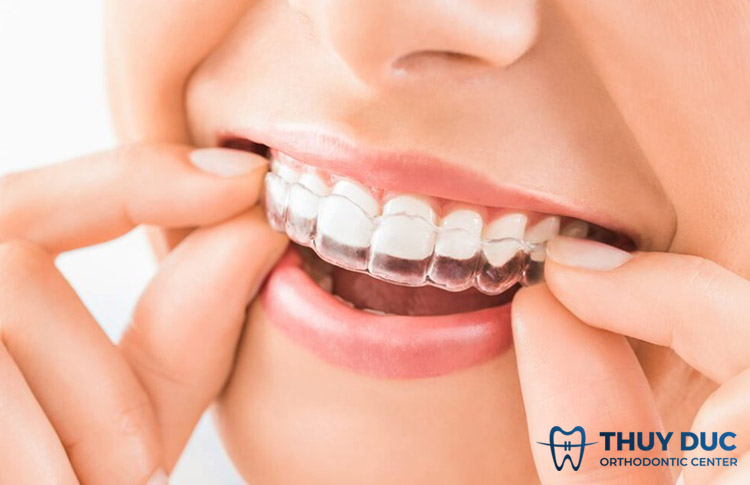 Niềng răng không mắc cài là gì? 1 Niềng răng không mắc cài là gì? 1