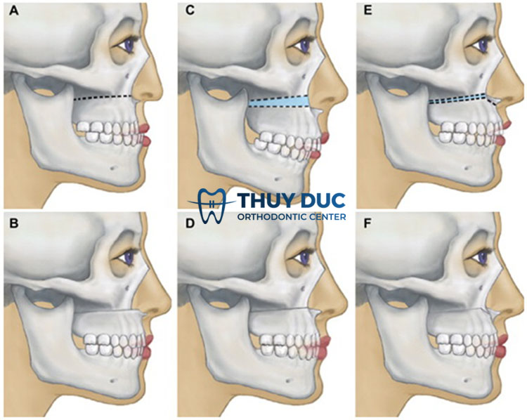 Điều trị móm răng ở người trưởng thành 2
