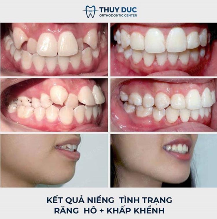 Địa chỉ nha khoa niềng răng lệch uy tín nhất 2