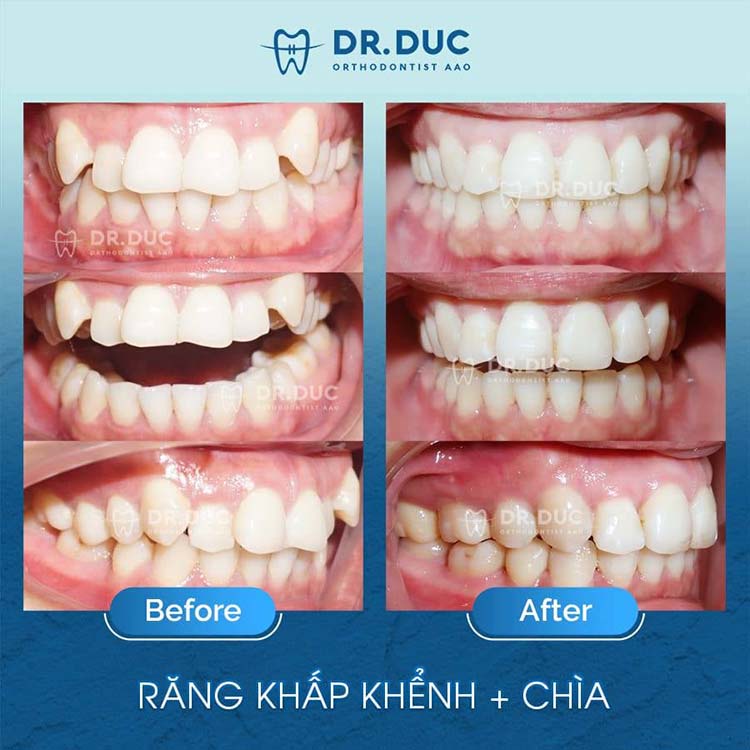 Địa chỉ nha khoa niềng răng lệch uy tín nhất 3