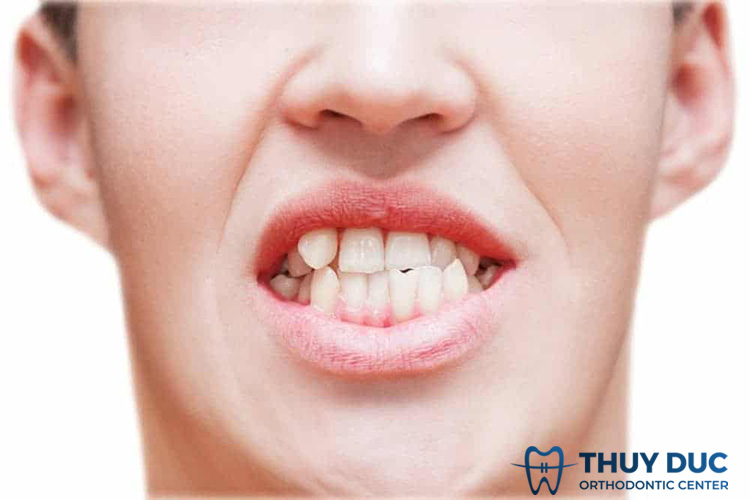 Tác động xấu của hàm răng bị lệch lạc 1