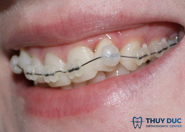 Vì sao khi niềng răng bạn cần sáp nha khoa? 1 Vì sao khi niềng răng bạn cần sáp nha khoa? 1