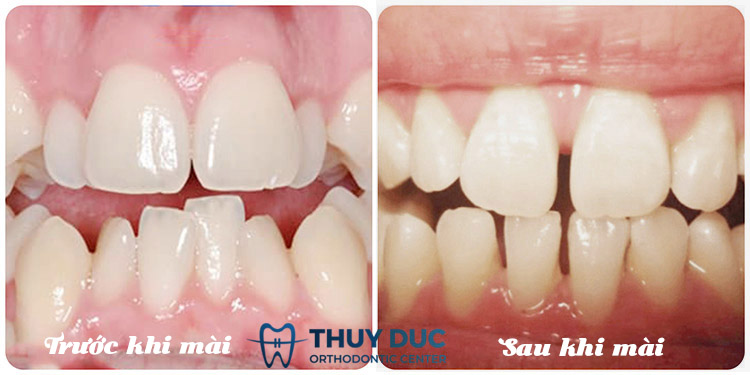 Mài kẽ răng 1 Mài kẽ răng 1