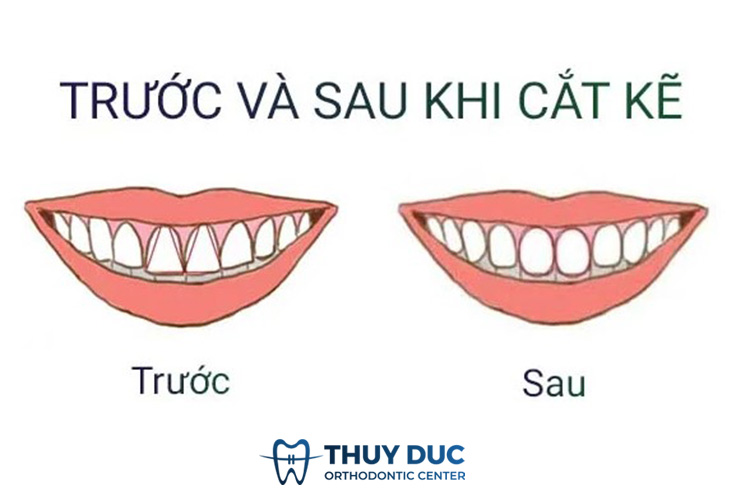 Những trường hợp nào cần mài kẽ răng trước khi niềng 1 Những trường hợp nào cần mài kẽ răng trước khi niềng 1