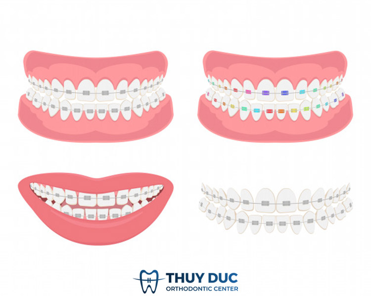Chi phí khi thực hiện chỉnh nha cố định 1