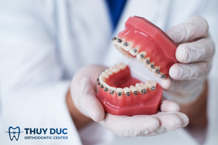 Chỉnh nha cố định là gì? 1