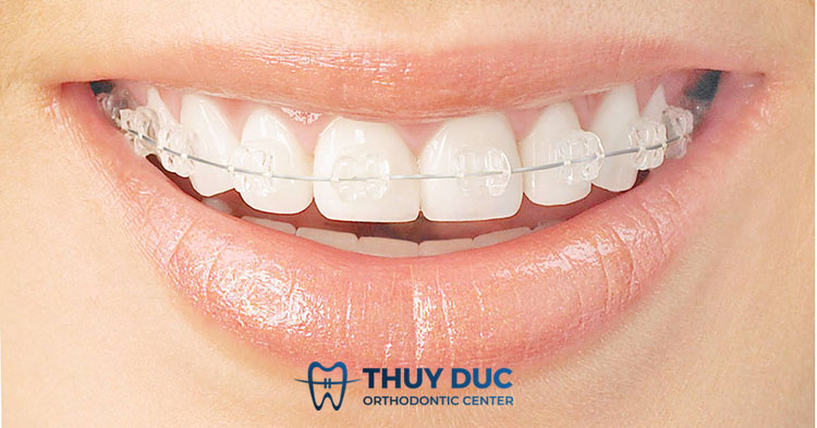 Chỉnh nha mắc cài sứ 1