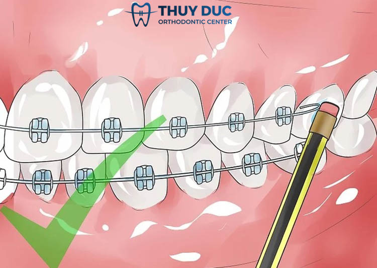 Các dụng cụ sửa dây cung 1 Các dụng cụ sửa dây cung 1