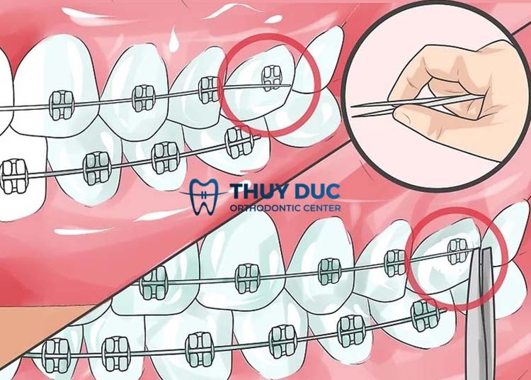 Các dụng cụ sửa dây cung 2 Các dụng cụ sửa dây cung 2