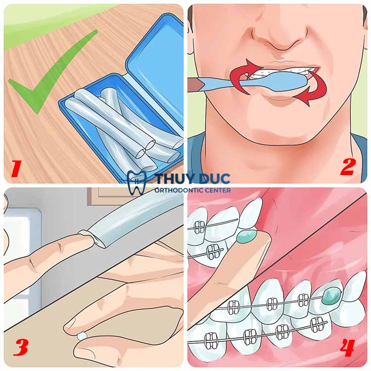Sử dụng sáp nha khoa 1 Sử dụng sáp nha khoa 1