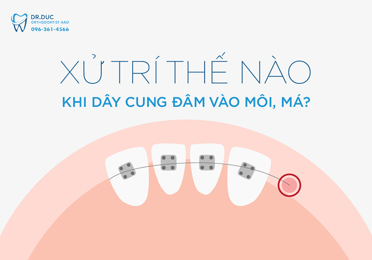  Dây cung niềng răng đâm vào má sẽ mang lại sự chuẩn bị tốt nhất cho nụ cười tươi sáng