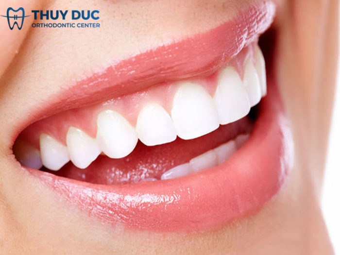 Tẩy trắng răng là gì? 1 Tẩy trắng răng là gì? 1
