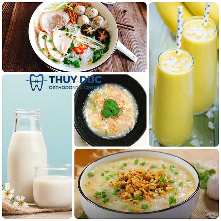 Sau khi chỉnh nha 1