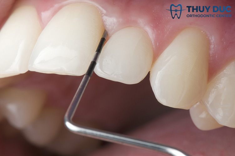 Tại sao cần mài kẽ răng để niềng răng? Có nguy hiểm không? 1 Tại sao cần mài kẽ răng để niềng răng? Có nguy hiểm không? 1