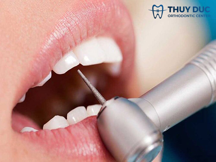 Mài kẽ răng là gì? Tại sao cần mài kẽ răng trước khi niềng răng? 1 Mài kẽ răng là gì? Tại sao cần mài kẽ răng trước khi niềng răng? 1