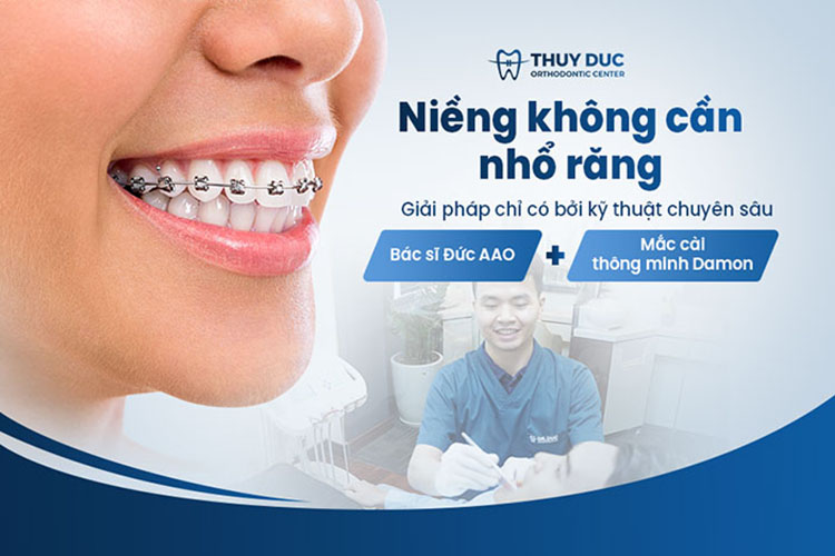 Phương pháp niềng răng không cần nhổ F.A.C.E tại Nha khoa Thúy Đức 1 Phương pháp niềng răng không cần nhổ F.A.C.E tại Nha khoa Thúy Đức 1