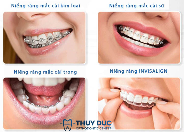 Niềng răng bao lâu phụ thuộc vào phương pháp điều trị 1 Niềng răng bao lâu phụ thuộc vào phương pháp điều trị 1