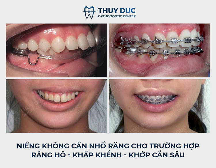 Phương pháp niềng răng không cần nhổ F.A.C.E tại Nha khoa Thúy Đức 3 Phương pháp niềng răng không cần nhổ F.A.C.E tại Nha khoa Thúy Đức 3