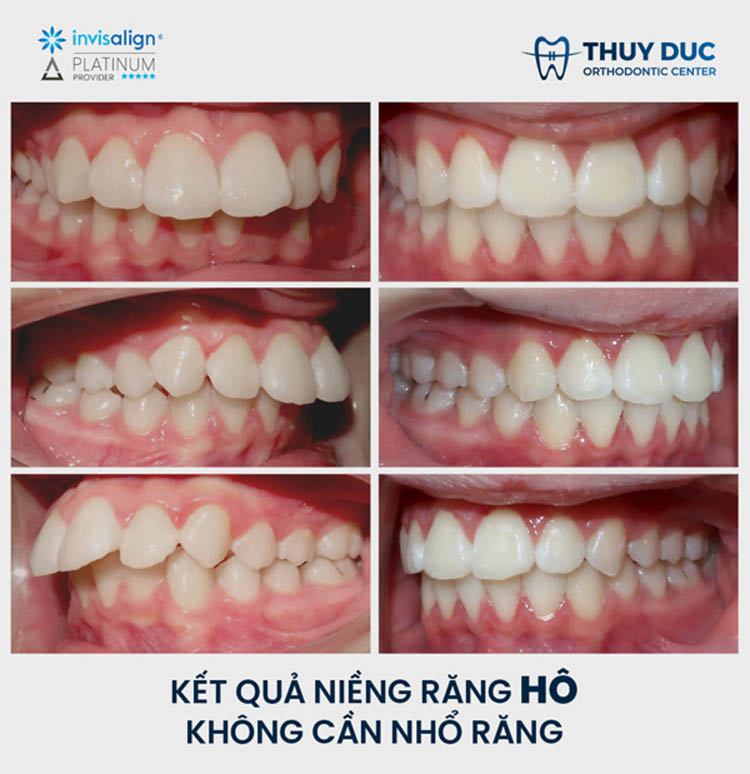Chỉnh nha cố định tại Nha khoa Thúy Đức uy tín, chất lượng 4