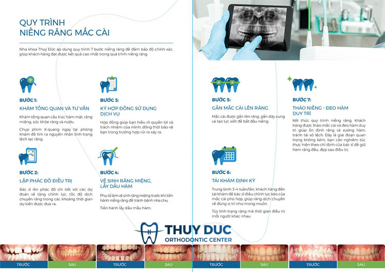 Quy trình thực hiện chỉnh nha cố định 1