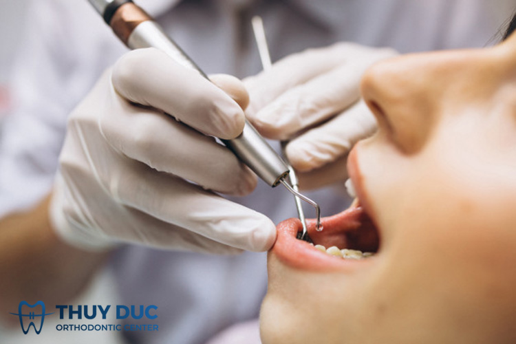 Mài kẽ răng để niềng răng được thực hiện ra sao? 1 Mài kẽ răng để niềng răng được thực hiện ra sao? 1