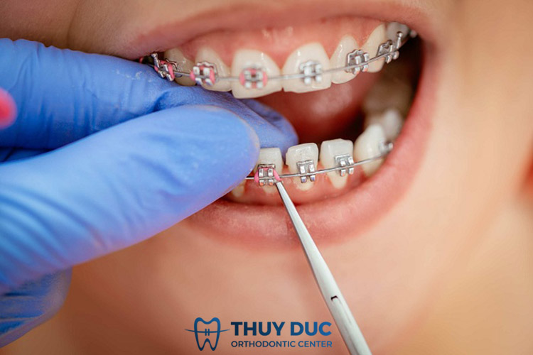 Lời khuyên của bác sĩ để ngăn ngừa dây cung đâm vào má 1 Lời khuyên của bác sĩ để ngăn ngừa dây cung đâm vào má 1