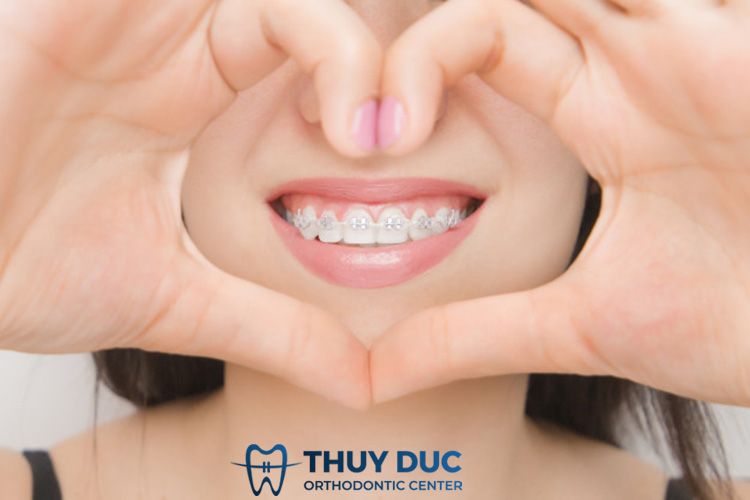 Ưu- nhược điểm của chỉnh nha cố định, ai phù hợp với phương pháp này? 1