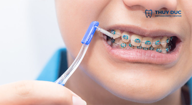 1. Vệ sinh răng miệng sau mỗi bữa ăn và ăn nhẹ để tránh hơi thở có mùi với niềng răng 1